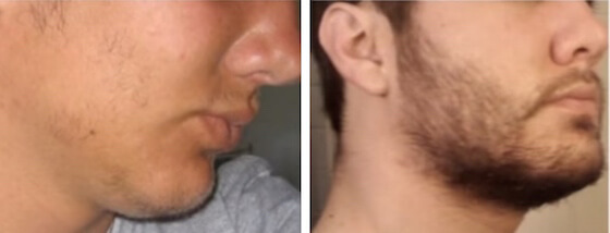 Minoxidil Bartwuchs nach 2.5 Monaten